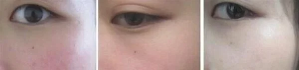 做激光祛红血丝费用大概需要多少