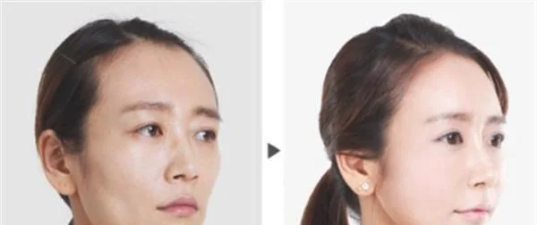 E光嫩肤有什么缺点？