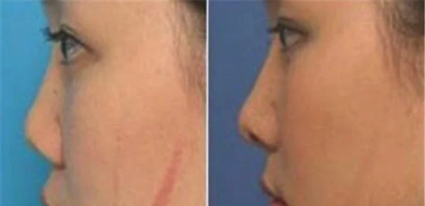 疤痕增生修复恢复需要注意什么？