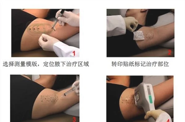 微波去除腋臭手术效果好不好？