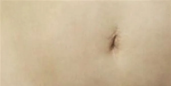 妊娠斑图片大全