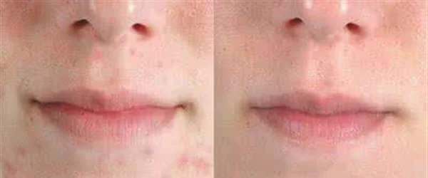 微晶磨皮去痘疤手术安全吗？