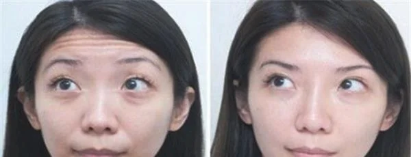 内窥镜除皱去抬头纹适合哪种人？