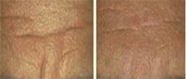 做E光除抬头纹价格贵不贵