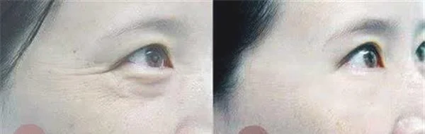 做胶原蛋白去鱼尾纹治疗效果怎么样？效果保持时间多久？