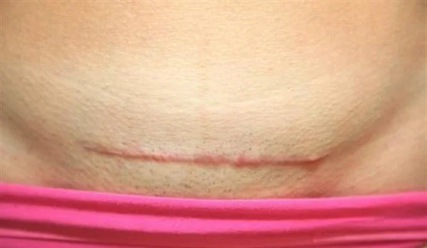 剖腹产疤痕修复手术注意事项是什么？