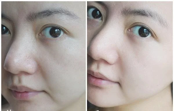 做去法令纹失败修复价格