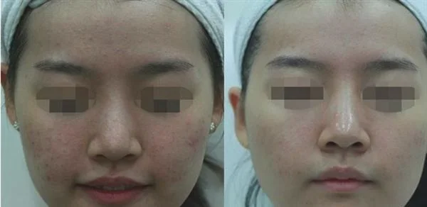 黑脸娃娃美白有副作用吗？