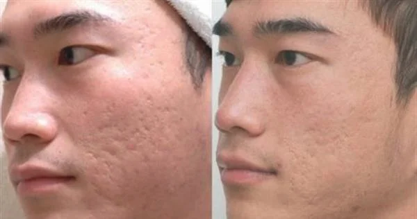做微晶磨皮去痘疤多少钱