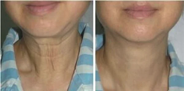 做玻尿酸除颈纹多少钱