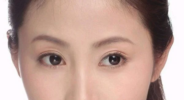 爱贝芙去法令纹多少钱