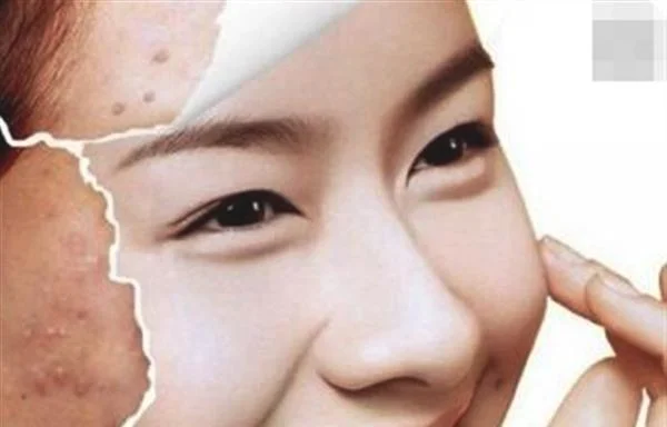 厦门 快速祛痘方法