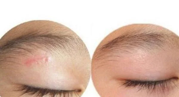 复合彩光祛疤效果怎么样术后如何护理。