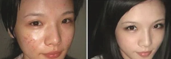 红蓝光祛痘优势