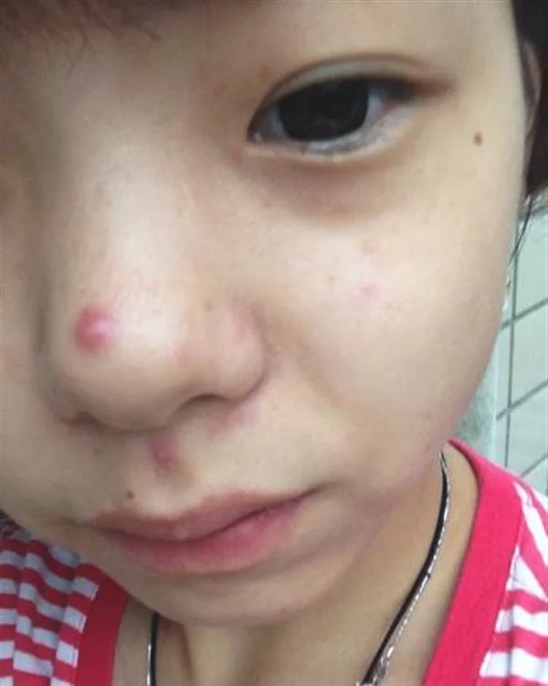 鼻尖长痘是什么原因