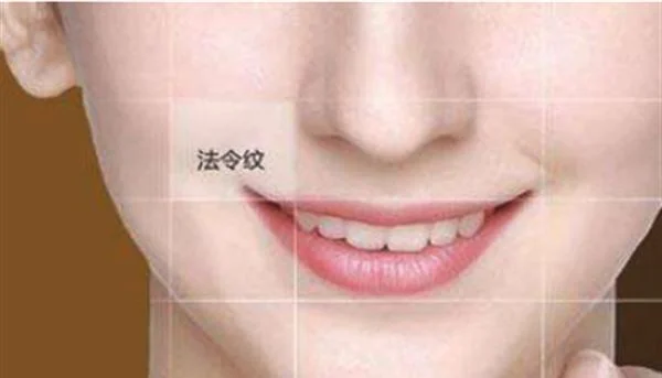 玻尿酸去法令纹的价钱
