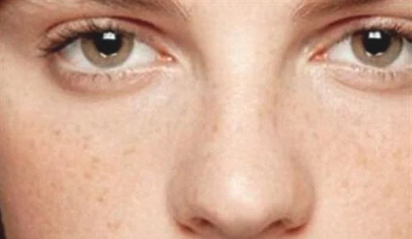 怎么祛斑不会反弹