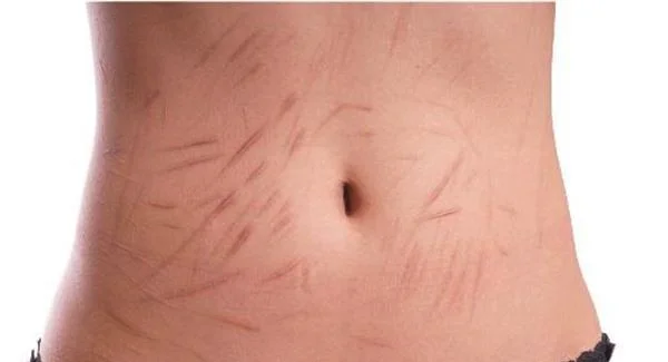 复合彩光祛疤效果怎么样有什么注意事项