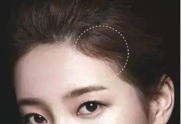 纹发际线的危害