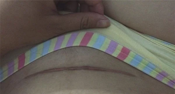 复合彩光祛疤适合哪些人