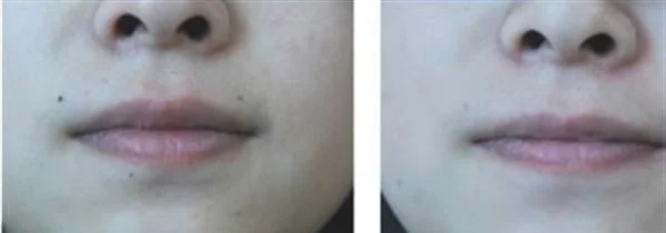 激光去痣要注意什么