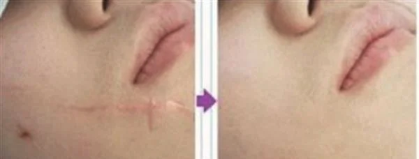 脸上疤痕怎样才能去掉
