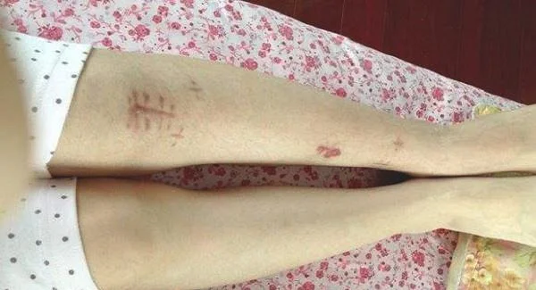 去疤痕手术的费用