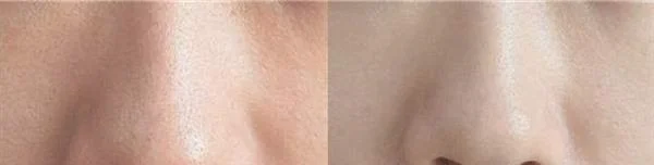 快速去黑头的简单方法