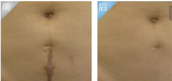 疤痕修复方法有哪些