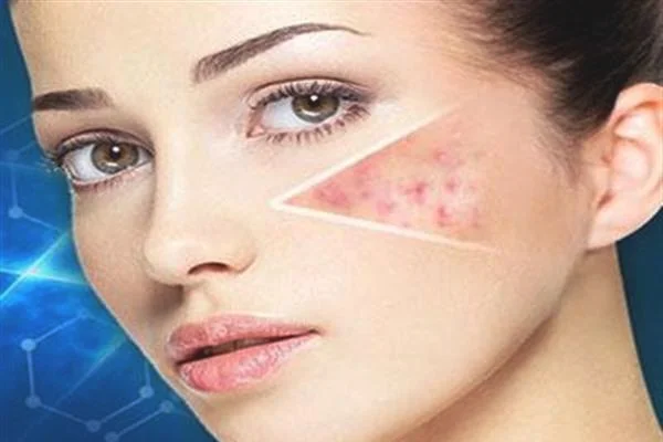 什么是红蓝光祛痘