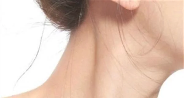 去颈纹手术价格