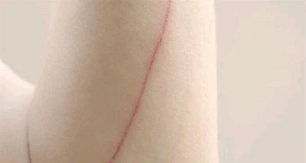 大腿烫伤留下疤痕怎么办