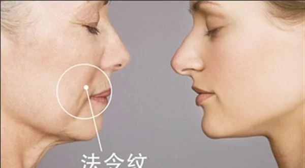 玻尿酸注射能消除法令纹吗