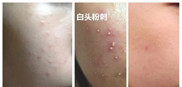 如何去粉刺