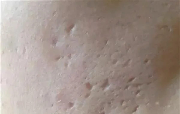 如何治疗痤疮伤疤效果好