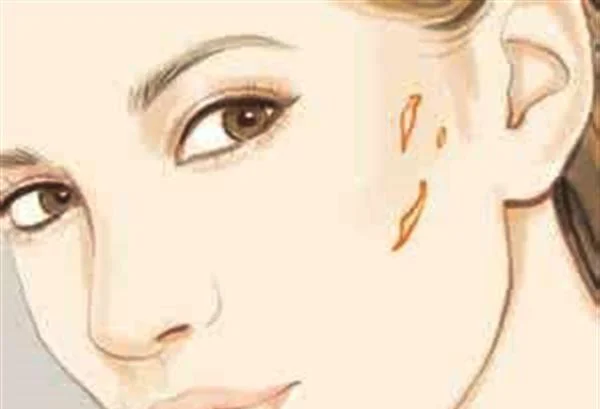 脸上伤疤怎样去除