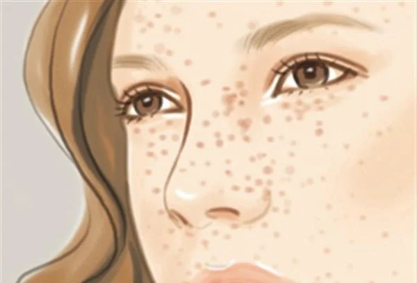 激光祛斑可以去干净吗