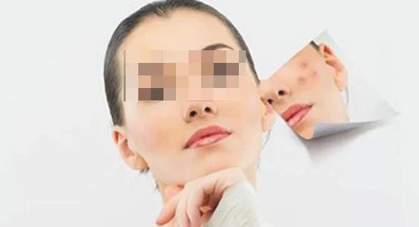 祛痘需要多少钱啊