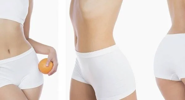 腹壁整形去妊娠纹多少钱