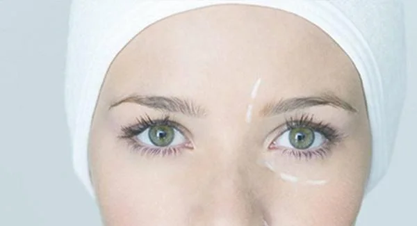 玻尿酸填鱼尾纹的效果安全吗