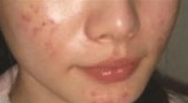 冷冻治疗去痘疤多少钱