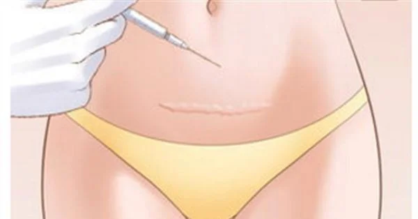 疤痕修复手术后注意事项有哪些