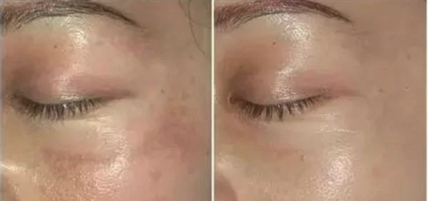 激光去除黄褐斑的方法真的有效吗