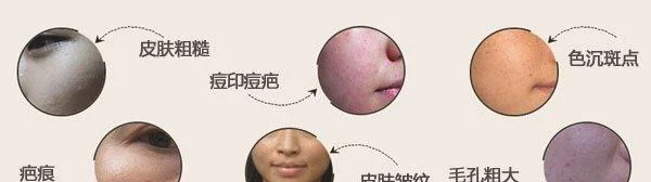 做像素激光的术后注意事项有哪些