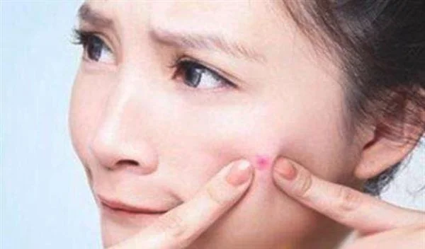 青春痘快速消除小妙招