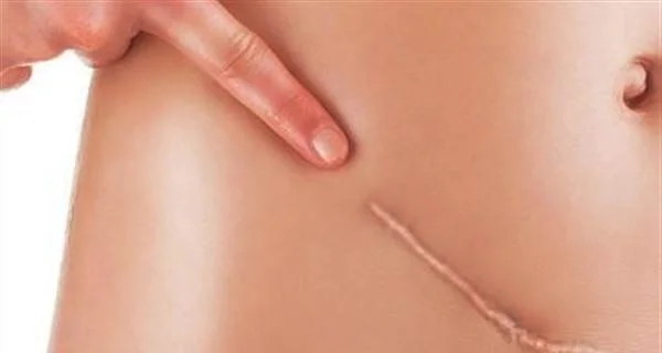 疤痕修复术的分类和手术方法