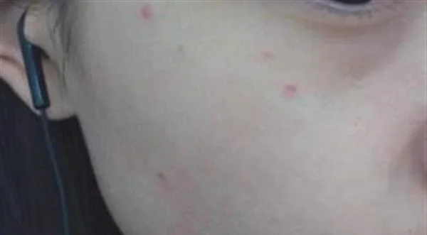 微晶磨削去黑痣多少钱