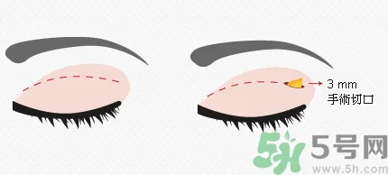 提眉术后多久可以恢复？提眉术后全过程照片