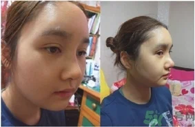 削骨瘦脸手术疼吗?削骨瘦脸手术危险吗?